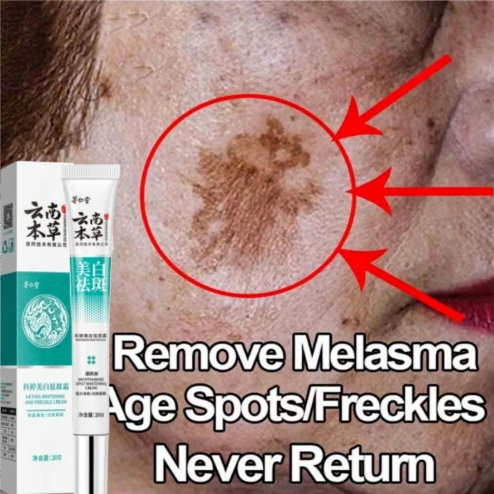 Powerful Herb Whitening Freckle Cream Remove Acne Dark Spot Melanin Fade Melasma Anti-Pigmentation Improve Dullness BrightenFace