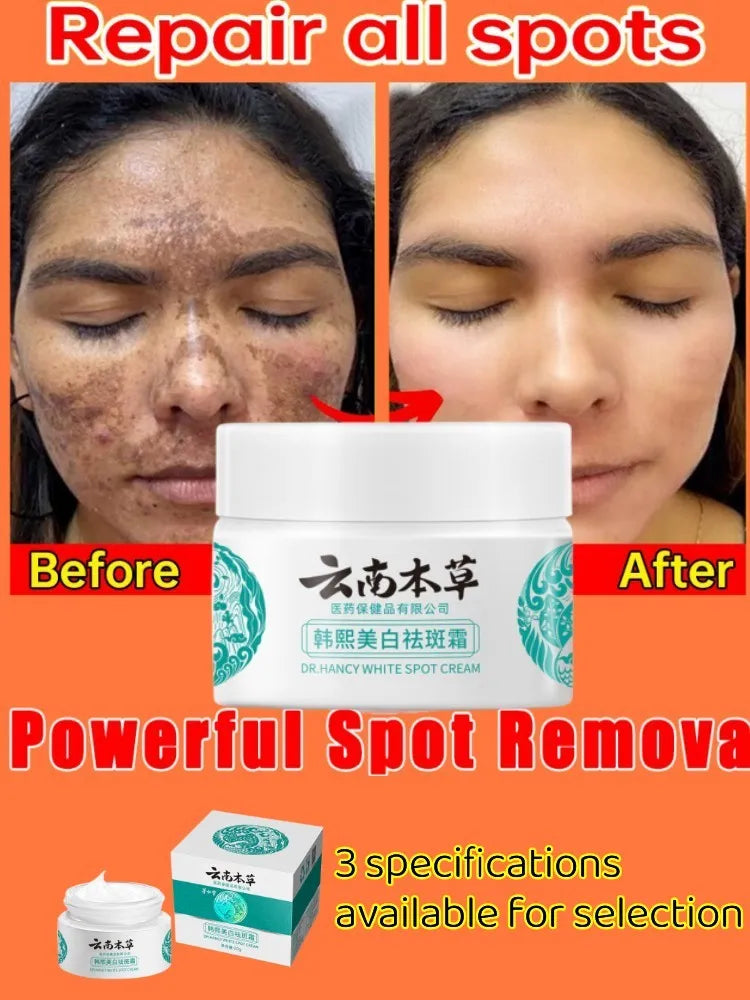 Powerful Herb Whitening Freckle Cream Remove Acne Dark Spot Melanin Fade Melasma Anti-Pigmentation Improve Dullness BrightenFace