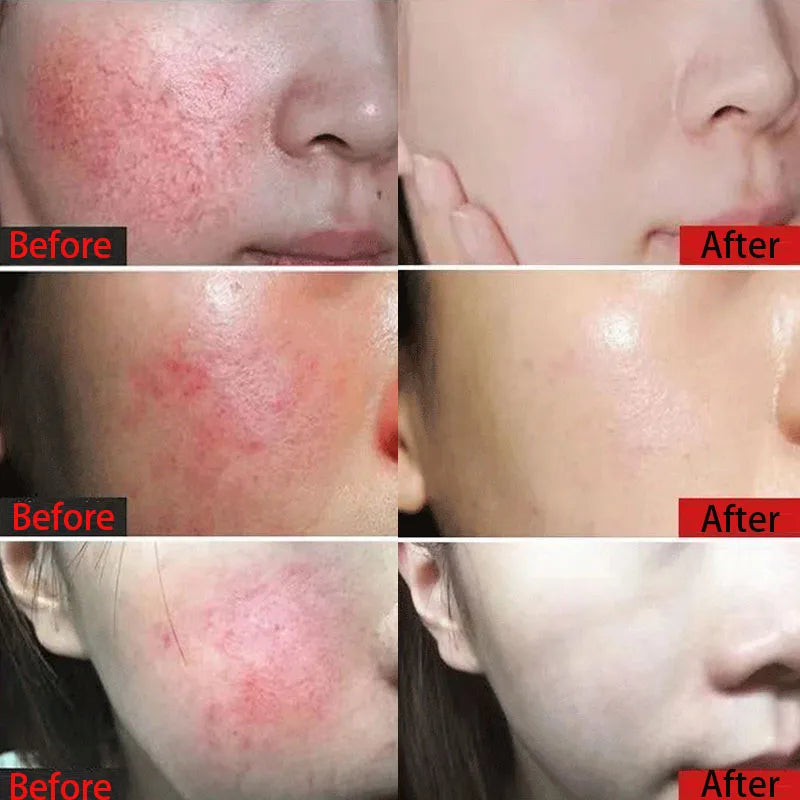 7 Day Repair Facial Redness Cream Soothing Redness Repair Skin Rosacea Red Blood Improve Sensitive Skin CareKorean Cosmetic